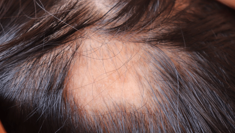 Patchy hair loss