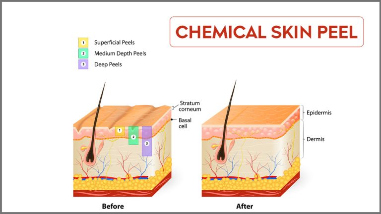 Skin Care Regime After Chemical Peel – Revive Clinic