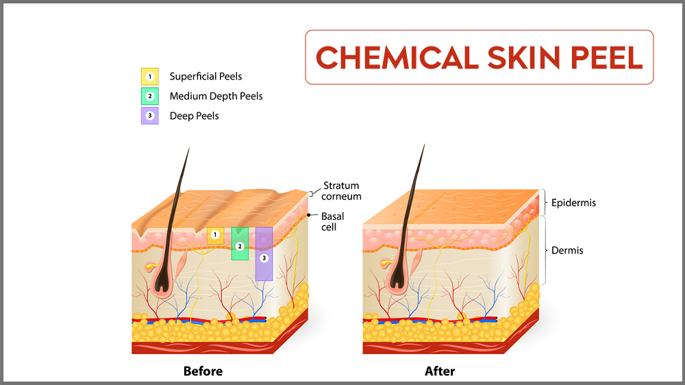 chemical skin peel treatment in mumbai
